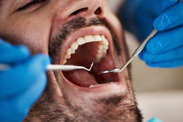 Best Emergency Tooth Extraction in Marlene Village, OR